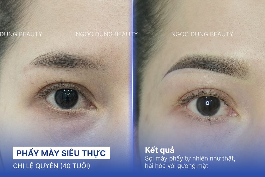 Trị sẹo rỗ – 6 liệu trình – Khắc phục sẹo chân vuông
