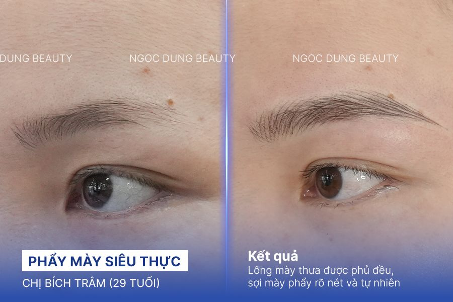Trị sẹo rỗ – 6 liệu trình – Khắc phục sẹo chân vuông