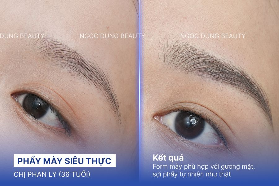 Trị sẹo rỗ – 6 liệu trình – Khắc phục sẹo chân vuông