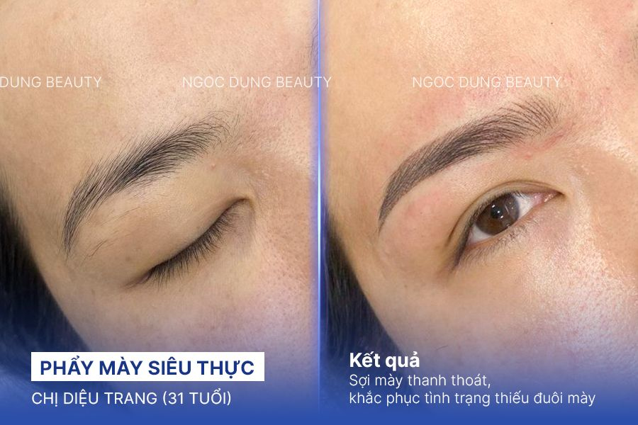 Trị sẹo rỗ – 6 liệu trình – Khắc phục sẹo chân vuông