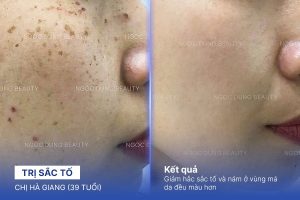 Chị Hà Giang (39 tuổi) - Trị Sắc Tố