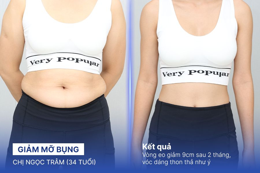 Giảm mỡ bụng – 4 liệu trình – Vòng eo giảm 9cm