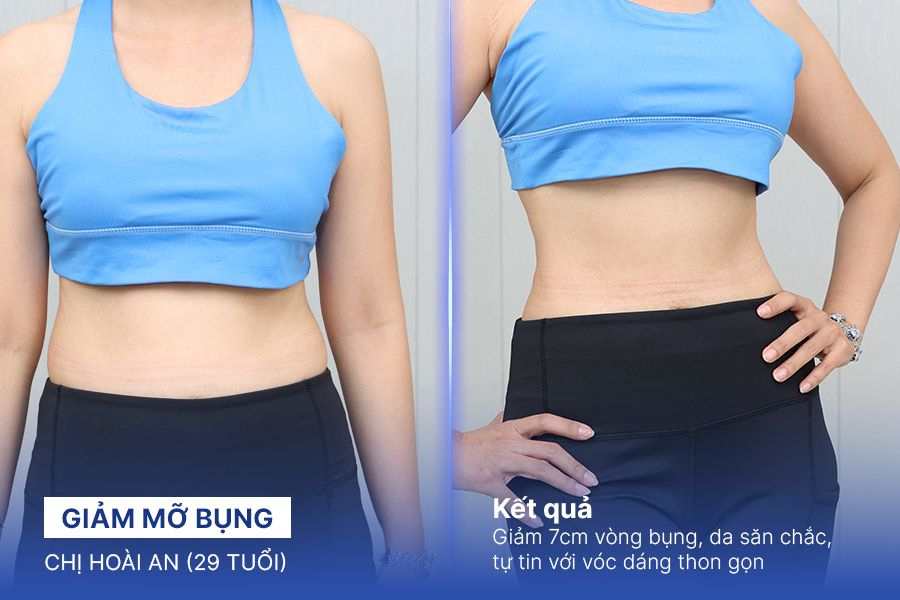 Giảm mỡ bụng – 3 liệu trình – Vòng bụng giảm 7cm