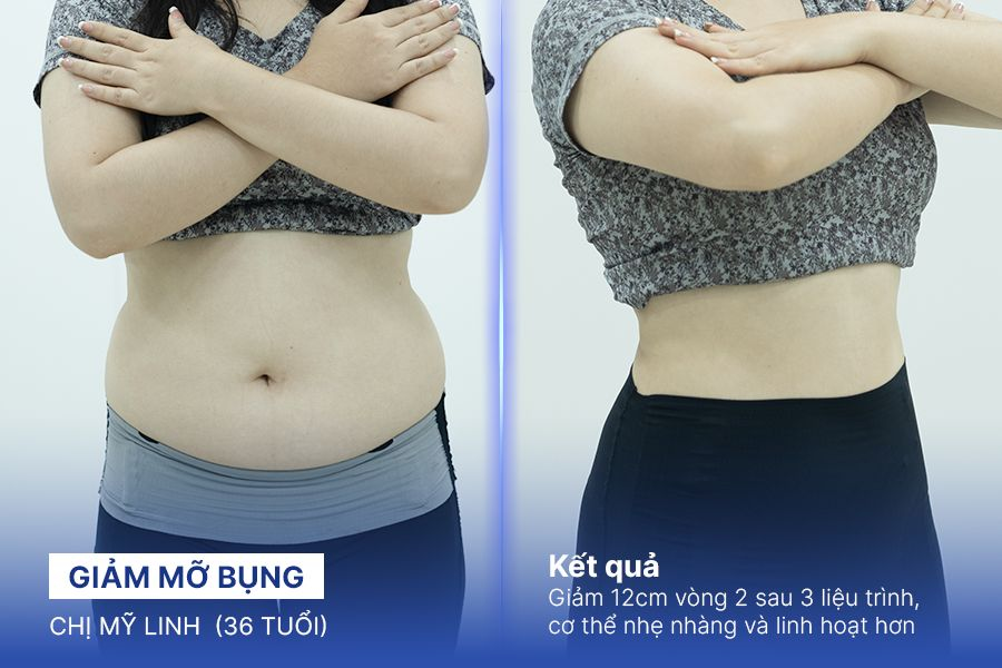 Giảm mỡ bụng – 3 liệu trình – Giảm 12cm vòng 2