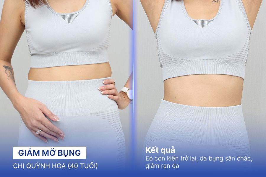 Giảm mỡ bụng – 3 liệu trình – Eo thon gọn thu hút