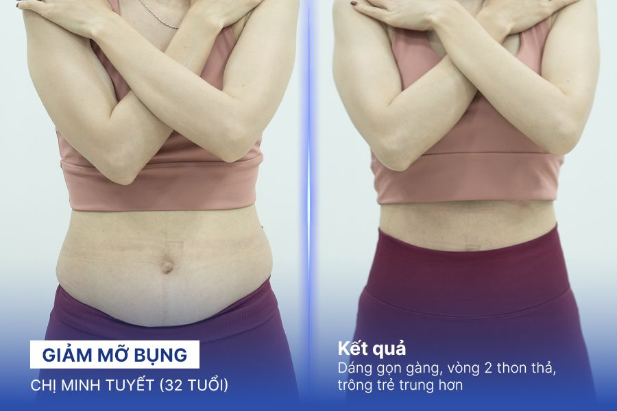 Giảm mỡ bụng – 2 liệu trình – Eo thon thả rõ rệt