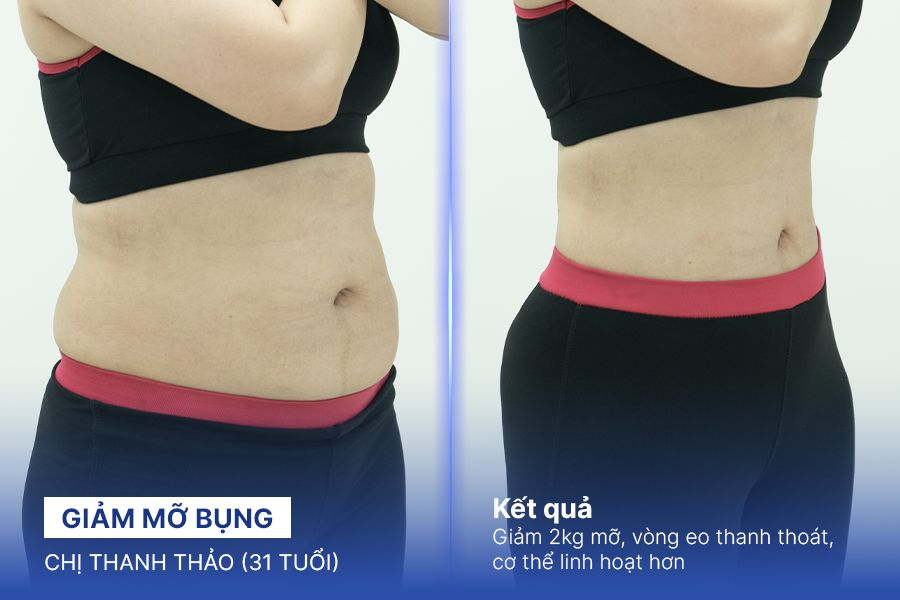 Giảm mỡ bụng – 4 liệu trình – Giảm ngay 2kg mỡ