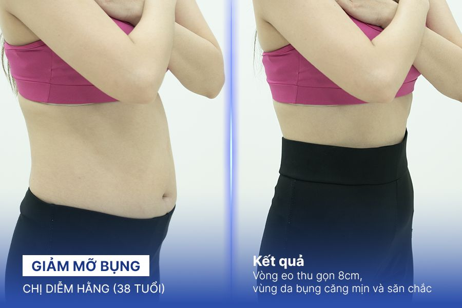 Giảm mỡ bụng – 3 liệu trình – Thu gọn 8cm vòng 2
