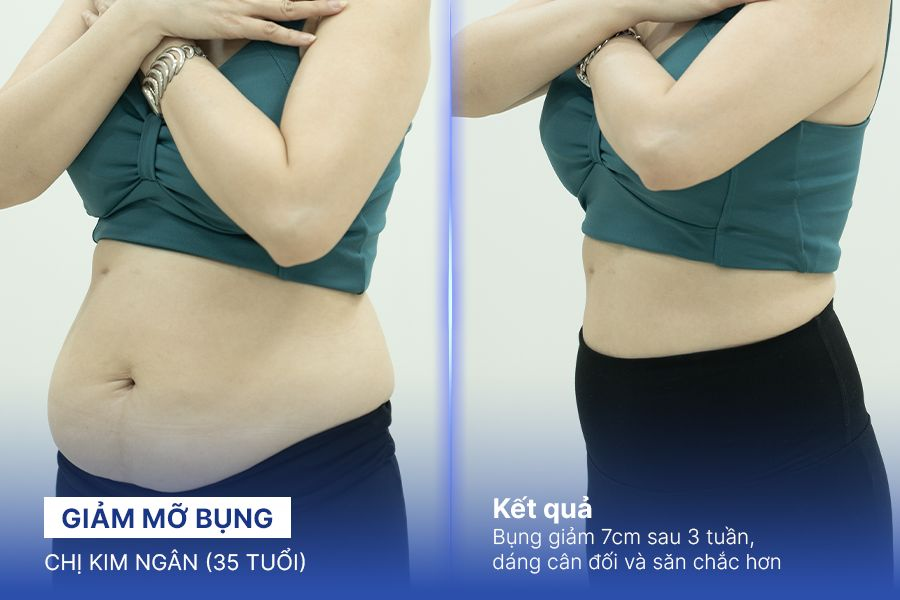 Giảm mỡ bụng – 2 liệu trình – Giảm 7cm vòng 2