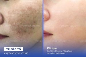 Chị Thảo Vy (33 tuổi) - Trị Sắc Tố