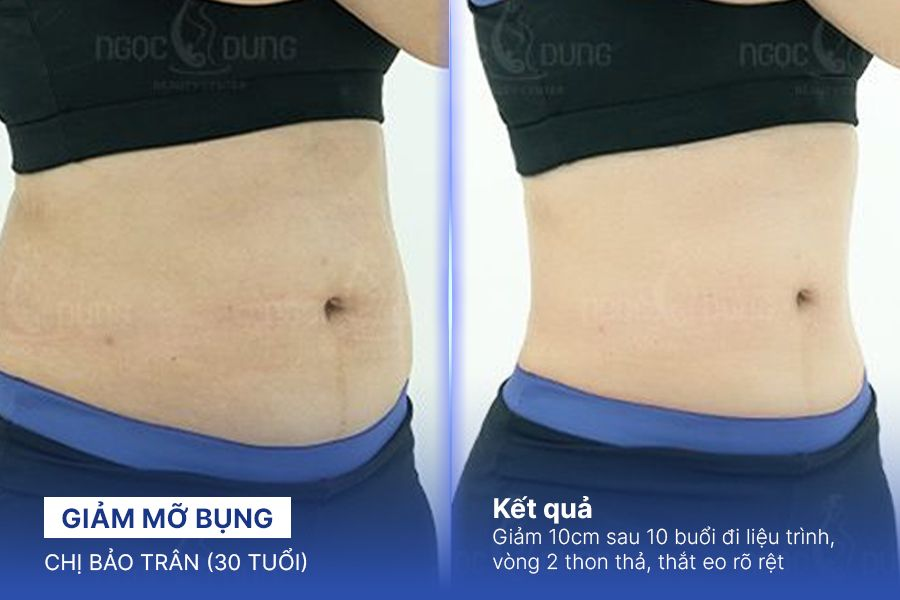 Giảm mỡ bụng – 5 liệu trình – Kiến tạo dáng chữ S