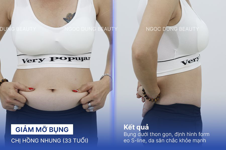 Giảm mỡ bụng – 4 liệu trình – Định hình eo Sline