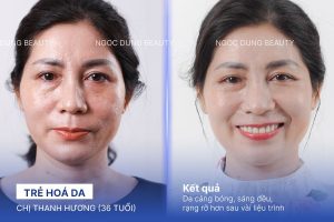 trẻ hoá da - chị thanh hương