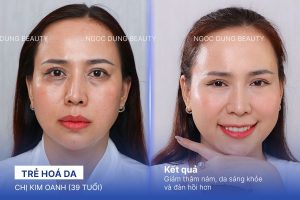 Chi Kim Oanh (39 tuổi) - Trẻ Hoá Da