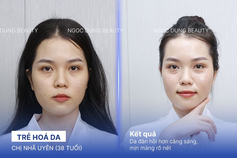 Chị Nhã Uyên (38 tuổi) - Trẻ Hoá Da