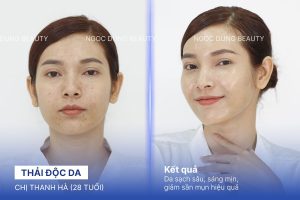 Chị Thanh Hà (28 tuổi) - Thải Độc Da