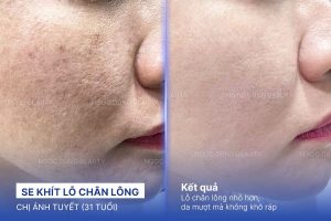 Chị Ánh Tuyết (31 tuổi) - Se Khít Lỗ Chân Lông