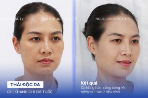 Chị Khánh Chi (26 tuổi) - Thải Độc Da