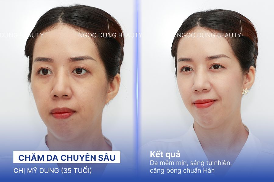 Chị Mỹ Dung (35 tuổi) - Chăm Da Chuyên Sâu