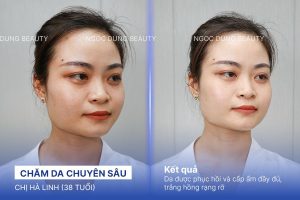 Chị Hà Linh (38 tuổi) - Chăm Da Chuyên Sâu