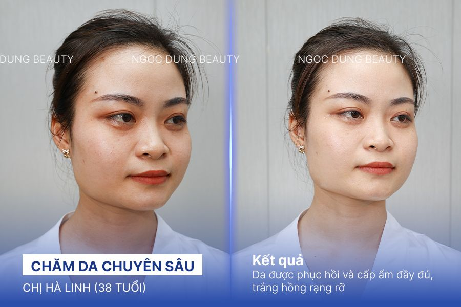 Chị Hà Linh (38 tuổi) - Chăm Da Chuyên Sâu