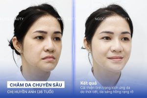 Chị Huyền Anh (36 tuổi) - Chăm Da Chuyên Sâu