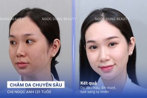 Chị Ngọc Anh (31 tuổi) - Chăm Da Chuyên Sâu