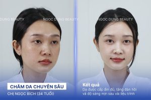 Chị Ngọc Bích (34 tuổi) - Chăm Da Chuyên Sâu