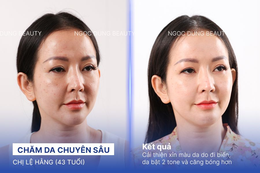 Chị Lệ Hằng (43 tuổi) - Chăm Da Chuyên Sâu