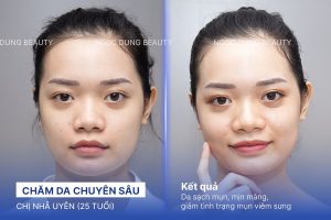 Chị Nhã Uyên (25 tuổi) - Chăm Da Chuyên Sâu