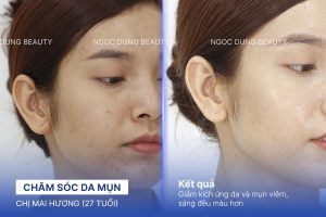 Chị Mai Hương (27 tuổi) - Chăm Sóc Da Mụn