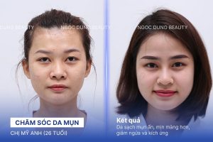 Chị Mỹ Anh (26 tuổi) - Chăm Sóc Da Mụn