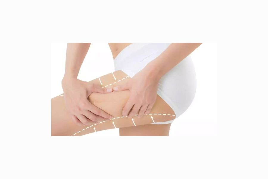 Chi phí hút mỡ đùi dao động từ 30 - 60 triệu đồng