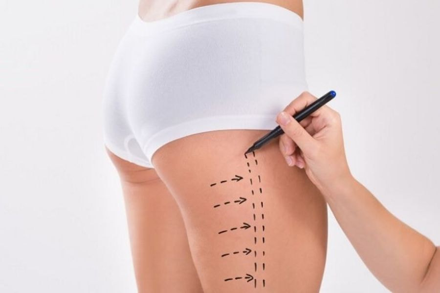 Hút mỡ đùi mang lại đôi chân săn chắc và cân đối