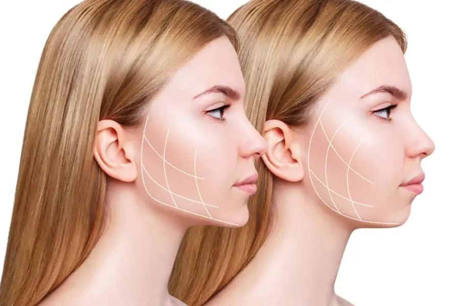 Hút mỡ mặt mang lại hiệu quả tức thì và lâu dài