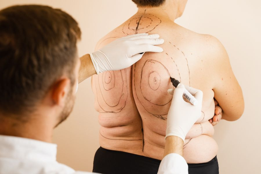 Bác sĩ sẽ tiến hành thăm khám kỹ lưỡng để đánh giá bệnh nhân có thể hút mỡ toàn thân hay không