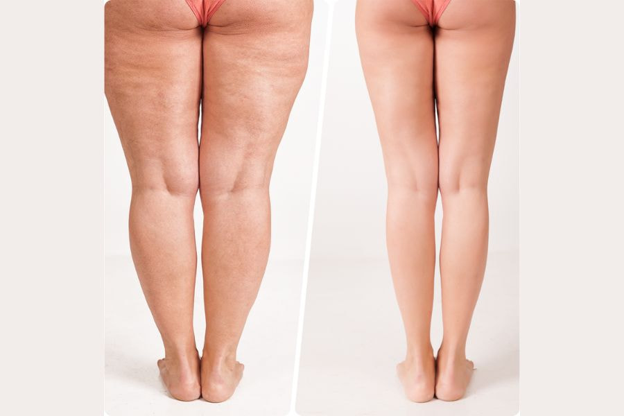 Tiêm tan mỡ đùi giúp bạn cải thiện độ tự tin về vóc dáng