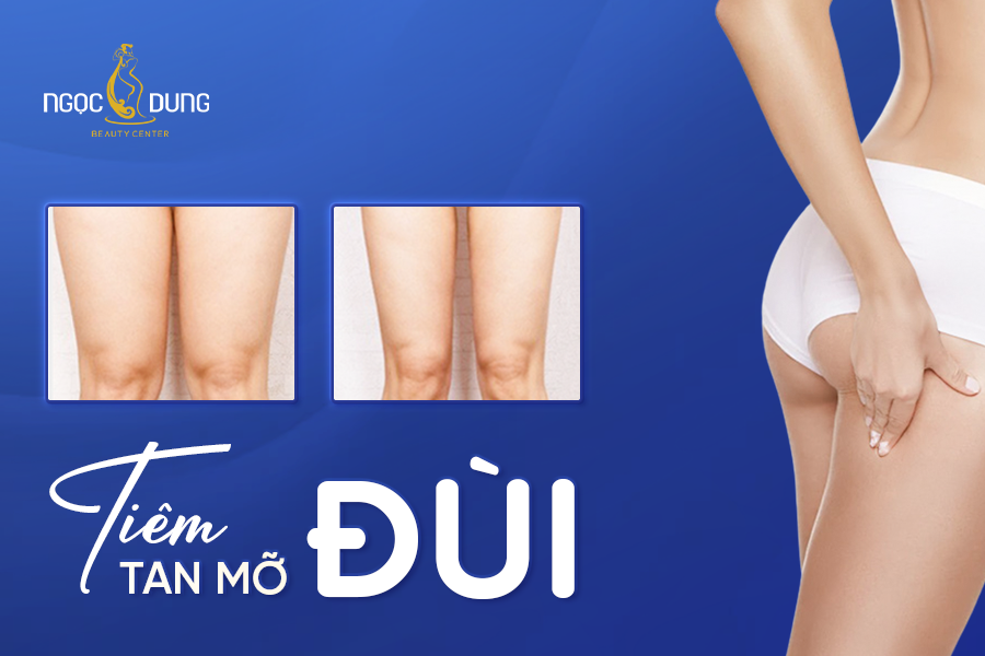 tiêm tan mỡ đùi