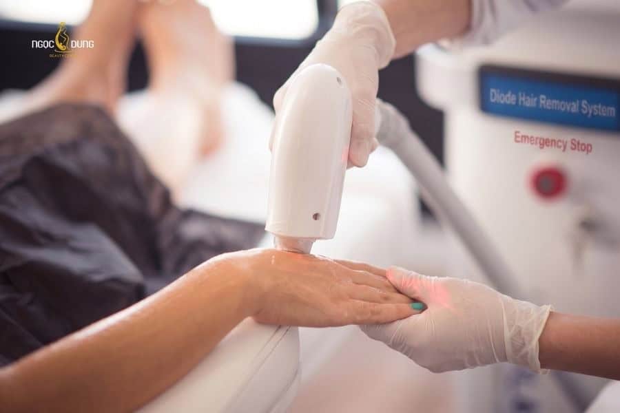 Triệt lông tay vĩnh viễn là phương pháp dùng công nghệ cao ức chế sự phát triển của gốc nang lông