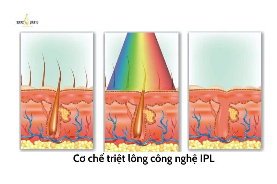 Triệt lông bằng công nghệ IPL thường là lựa chọn phổ biến vì phù hợp với nhiều vùng da