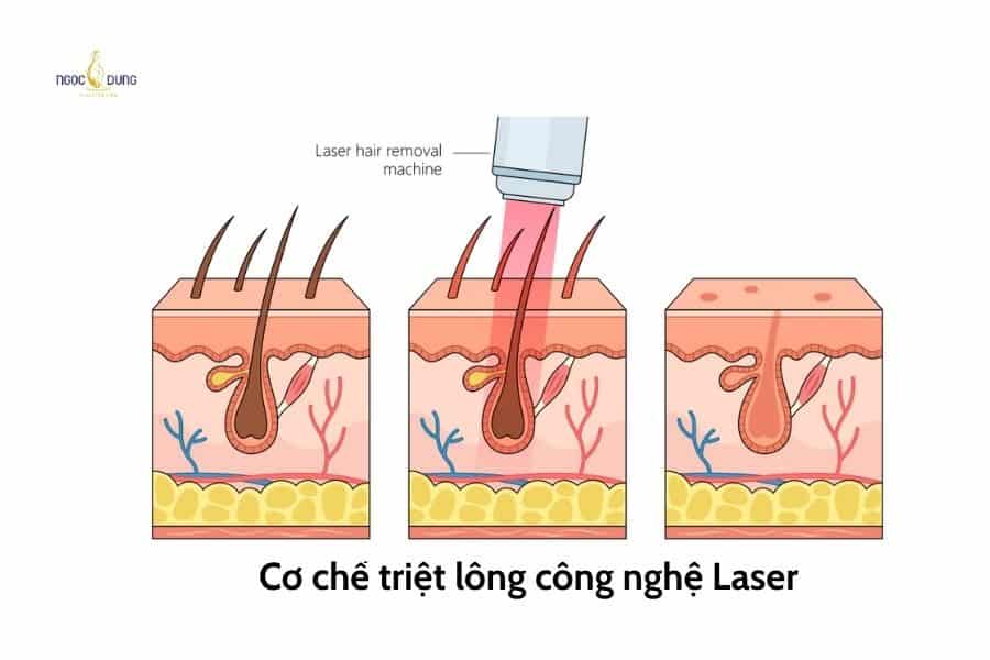 Triệt lông tay với công nghệ Diode Laser
