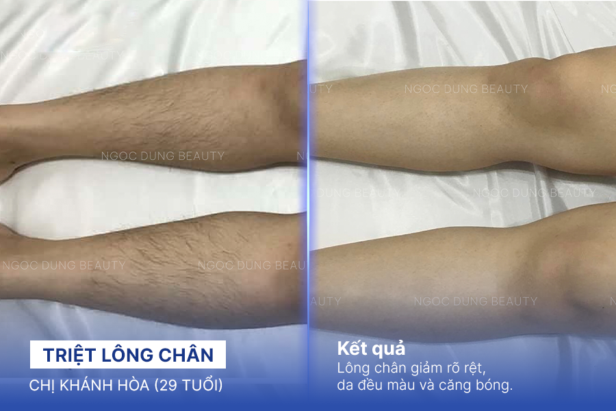 Làn da chân trông mịn màng và sạch thoáng hơn sau triệt lông, giúp tổng thể đôi chân thêm chỉn chu