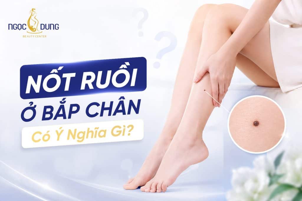 Nốt ruồi ở bắp chân có an toàn không? Khi nào cần xóa?