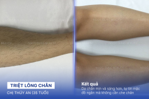 Triệt lông chân – 6 buổi – Da chân sáng mịn khỏe khoắn