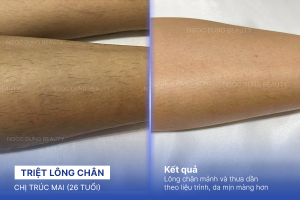 Triệt lông chân – 7 buổi – Sạch lông chân an toàn