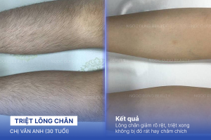 Triệt lông chân – 8 buổi – Tự tin diện váy ngắn