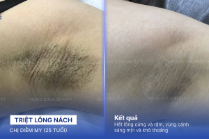 Triệt lông nách – 10 buổi – Lông mọc chậm và thưa hơn