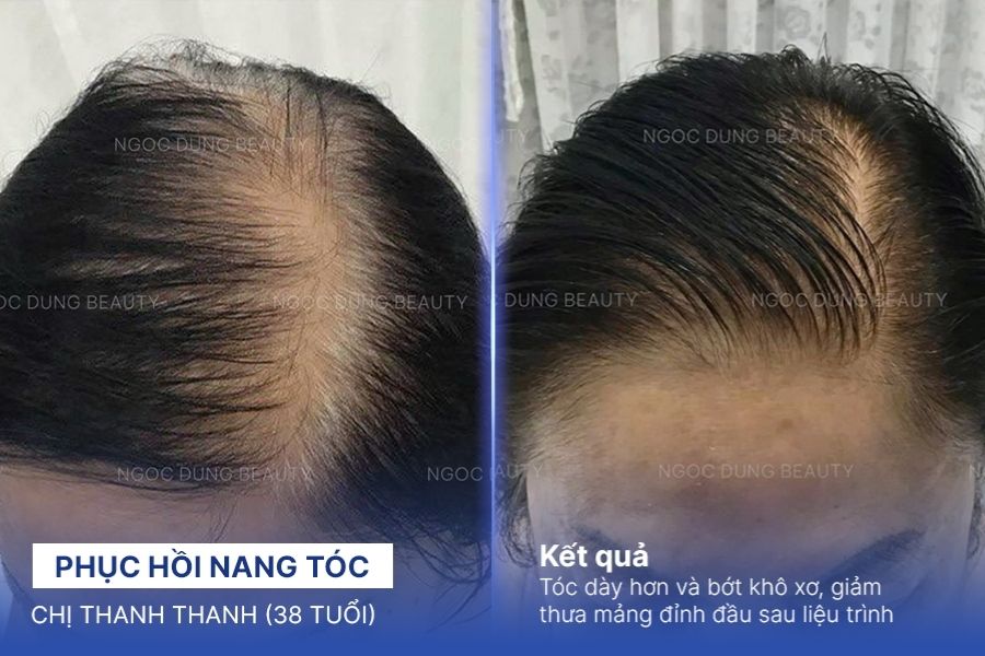 Kết quả phục hồi tóc AGING HAIR PLUS HMPF tại Ngọc Dung