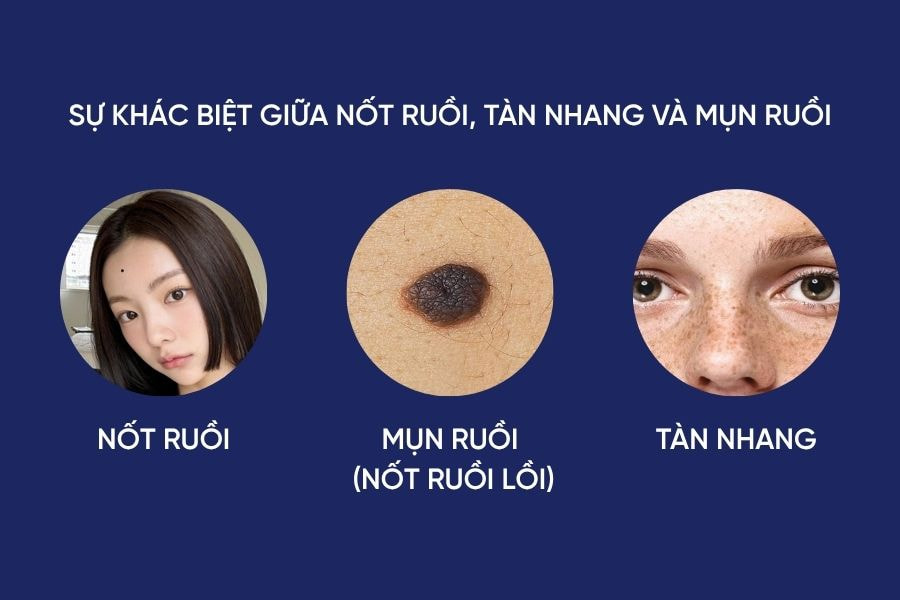 Hiểu rõ sự khác biệt giữ nốt ruồi, tàn nhang và mụn ruồi giúp bạn biết cách chăm sóc và can thiệp thẩm mỹ khi cần thiết