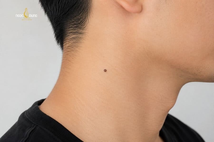 Nốt ruồi ở cổ nam bên phải thường có vận may trong công việc
